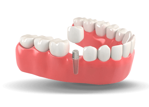 Dental Implants