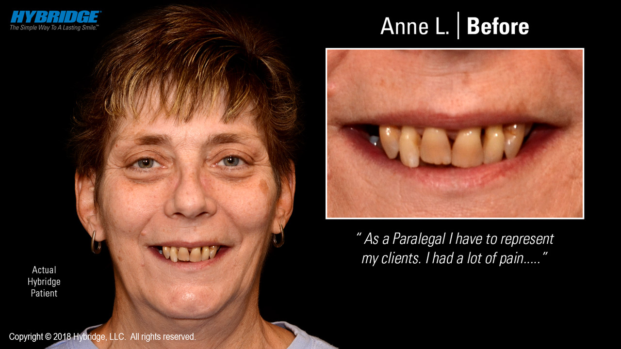 Anne L. Before