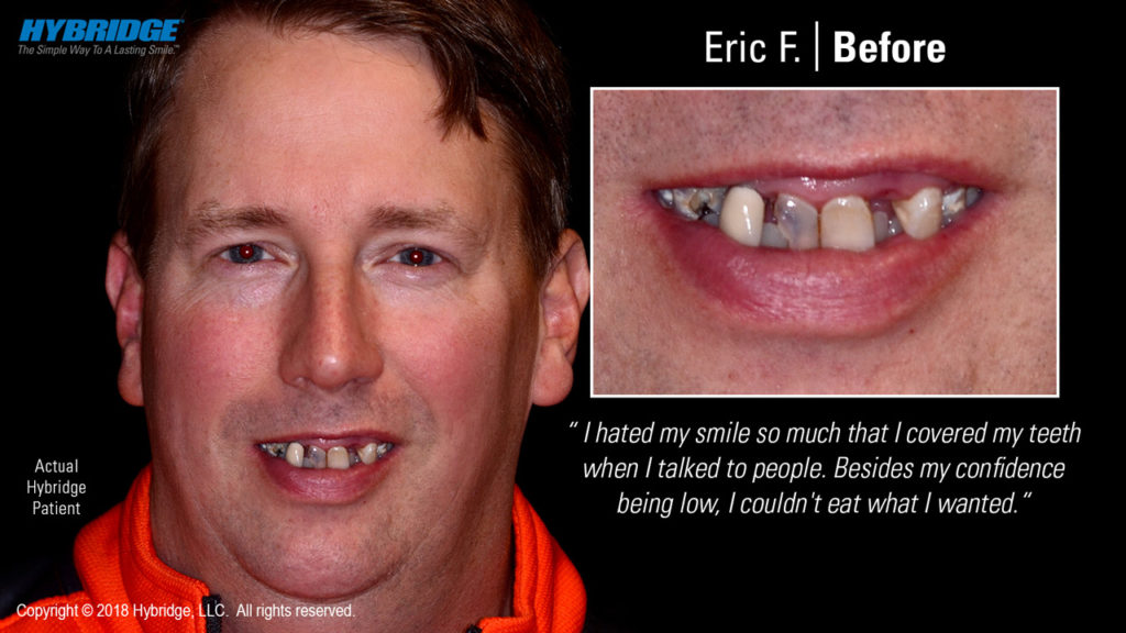 Eric F Before